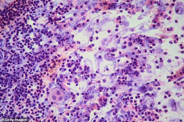 San Francisco's Archbishop Riordan High School Faces Deadly TB Outbreak as Health Officials Sound Alarm