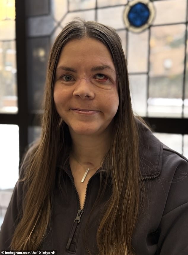 Kenai mother reveals devastating injuries eight months after grizzly bear mauling.