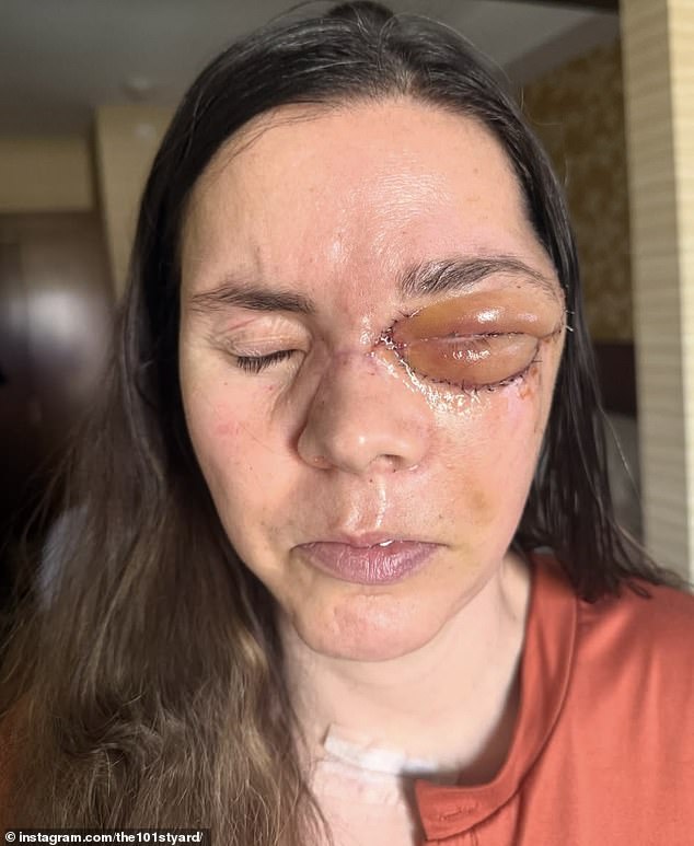 Kenai mother reveals devastating injuries eight months after grizzly bear mauling.