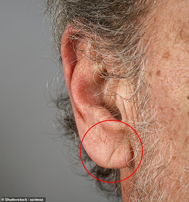 Earlobe Shape May Reveal Hidden Risk for Deadly Heart Disease