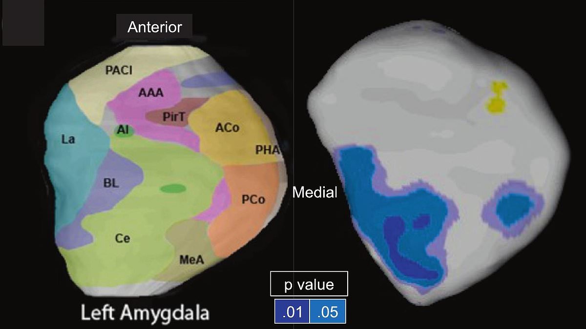 Premeditated Killers Show 14.3% Smaller Amygdala in New Brain Scan Study