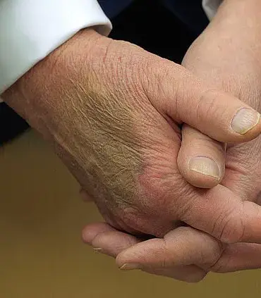 Trump's Hand Bruise Sparks Online Concern but Expert Advice Says Not to Speculate