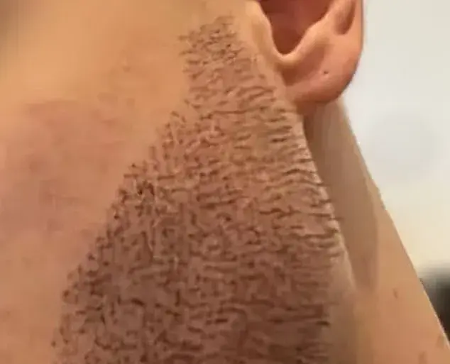 Exclusive: Dallas Surgeon Exposes Hidden Dangers of Global Hair Transplant Clinics