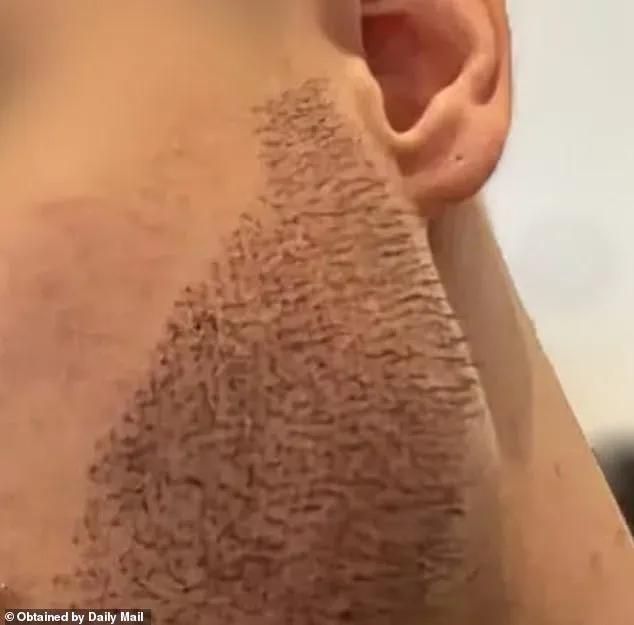 Exclusive: Dallas Surgeon Exposes Hidden Dangers of Global Hair Transplant Clinics