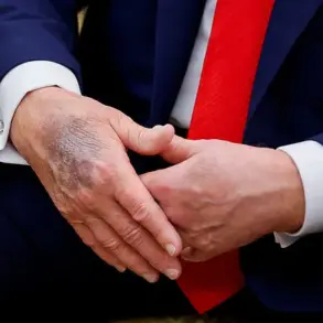 Recurring Bruises on President Trump's Hands Spark Health Concerns and Medical Speculation