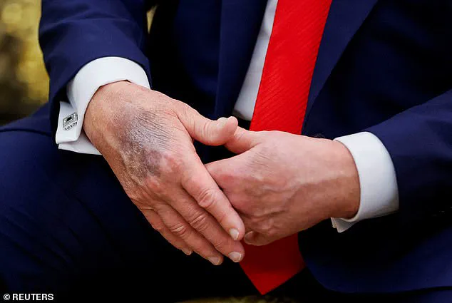 Recurring Bruises on President Trump's Hands Spark Health Concerns and Medical Speculation